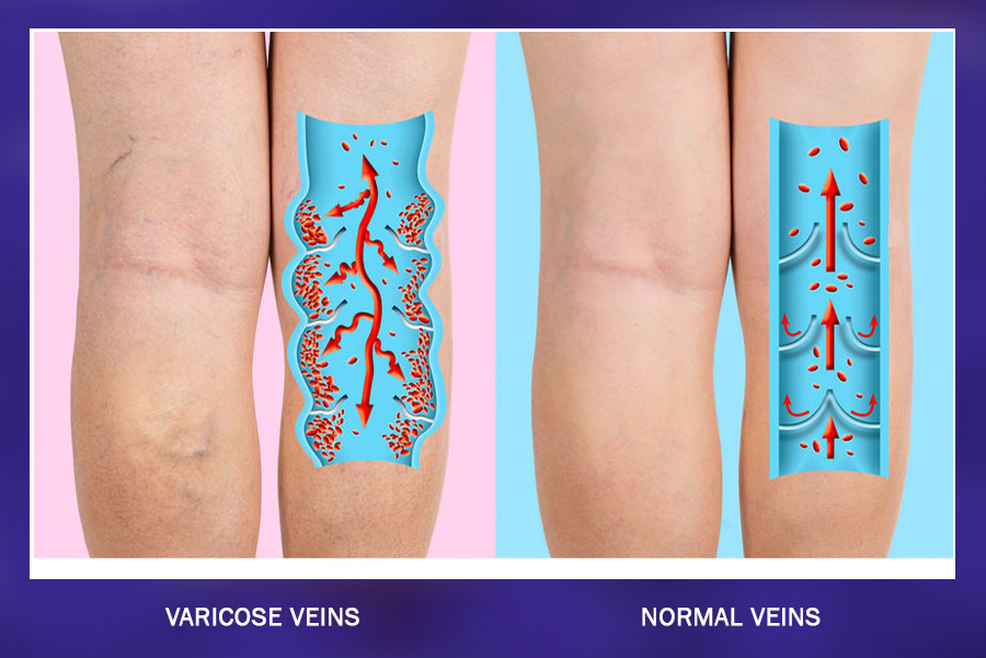 SVS: When do varicose veins need medical attention?